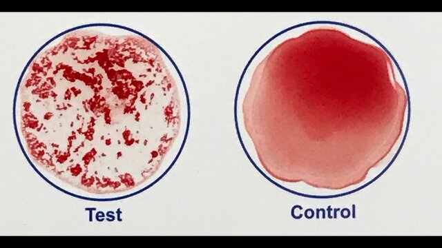 Scientists began developing blood-screening tests for infectious diseases
