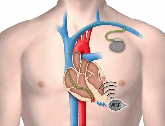 MARCAPASOS CARDIACOS