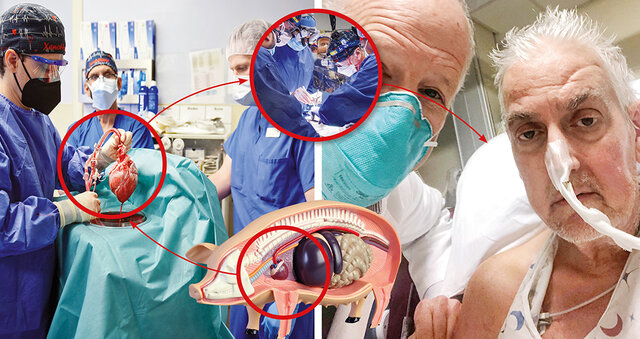 Transplante de Corazon