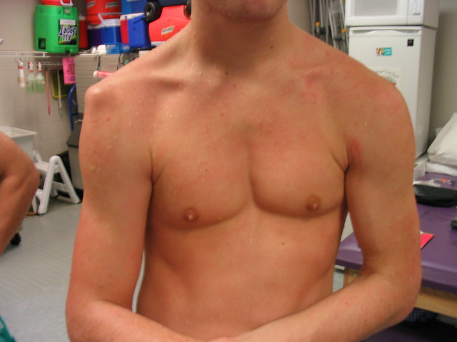 Athlete 2-inflammation stage