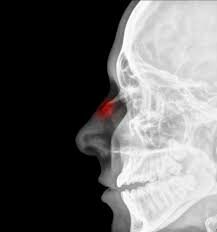 Primera lesió (nas trencat)