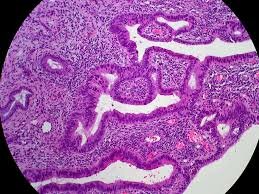 Biopsia Líquida para el Cáncer