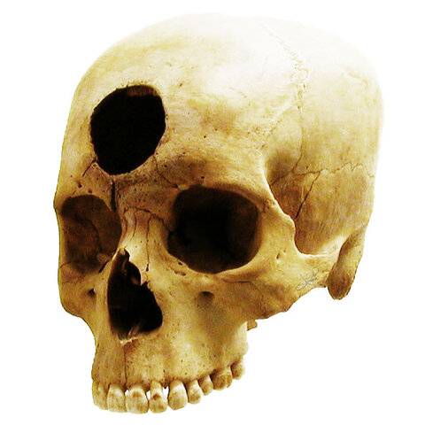 Primeras evidencias de trepanaciones