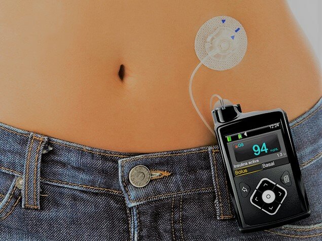Parches y bombas de insulina