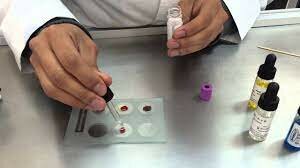 Sistema ABO de Determinación del Grupo Sanguíneo