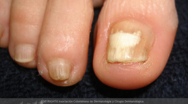 hongos y onicomicosis