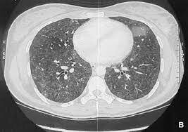 Descubrimiento de la bronquitis