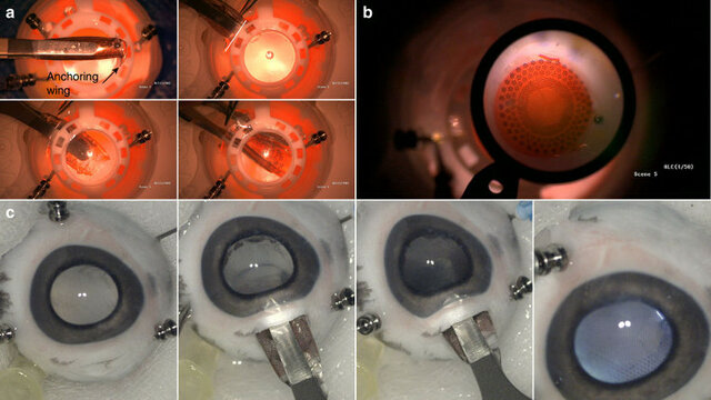 Un implante que revierte la ceguera