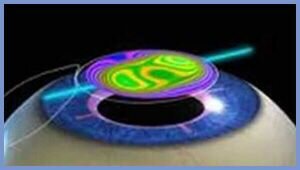 PMMA en cirugia ocular