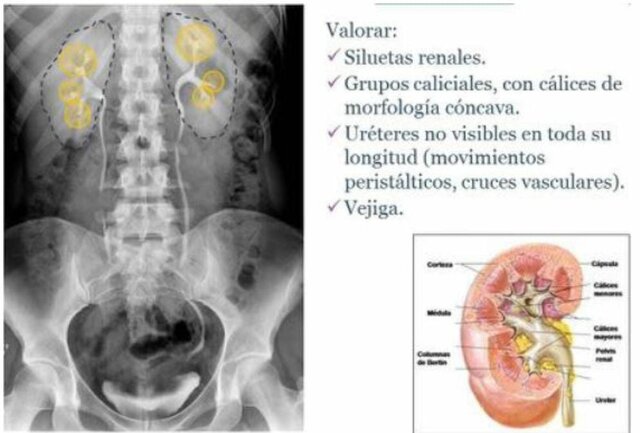 Urografía