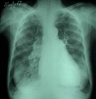 Descubrimiento de la bronquitis