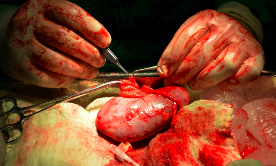 Primer trasplante de riñon con exito