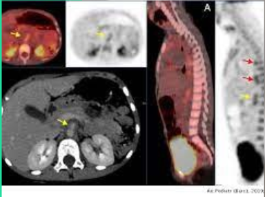 Combinación de PET con TAC