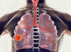 Vacuna contra la tuberculosis