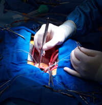 Trasplante de corazon con exito