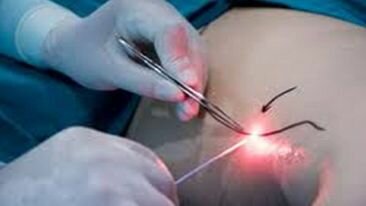 Cirugía utilizando laser