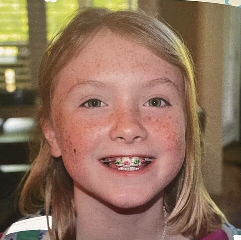 Me pusieron frenillos