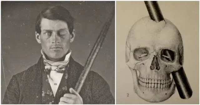 Phineas Gage