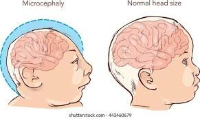 Microcefalia