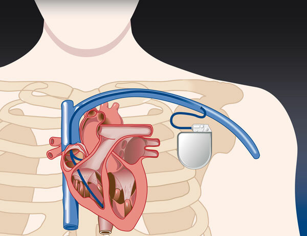 implantamiento del primer marca-pasos