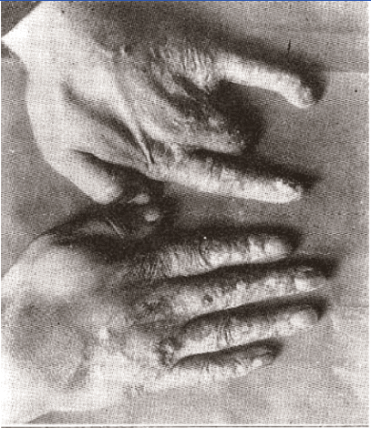 First Case of X-Ray Induced Dermatitis is Published