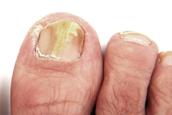 hongos y onicomicosis