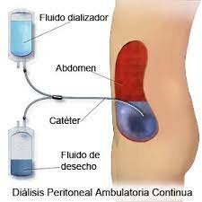 Desarrollo de la diálisis para la insuficiencia renal