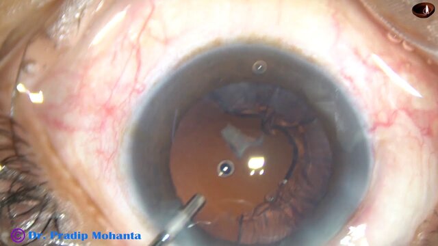 La primera cirugía de trasplante