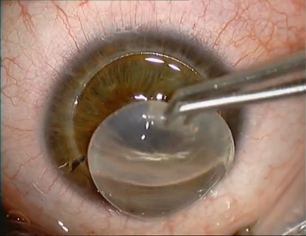 Primer transplante en humanos