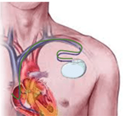 Marcapasos cardiaco
