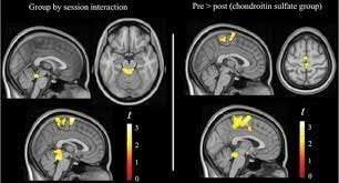 EN LA DÉCADA DE 1990 LA INVESTIGACIÓN AVANZA DE LA MANO DE IMÁGENES NO YA ANATÓMICAS, SINO FUNCIONALES.