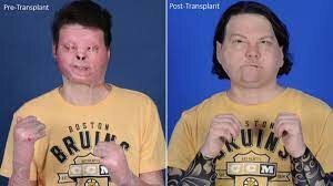 Trasplante de rostro