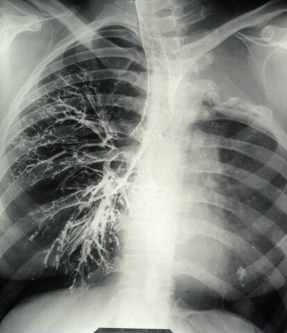 The Consequences of the Ever Changing Healthcare Industry on TB