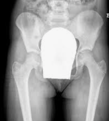 NCRP Recommends Discontinuing Patient Gonadal Shielding