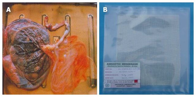 The Central Tissue Bank starts routinely using ionizing radiation to sterilize connective tissue grafts