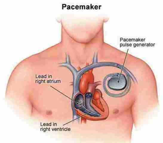 First Pacemaker Implant