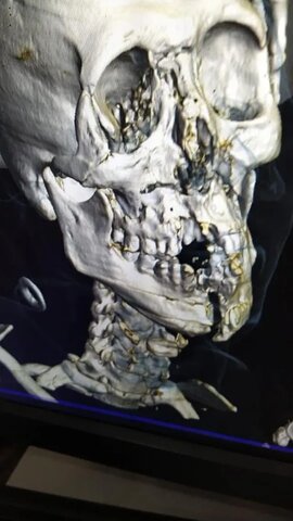 El cráneo del arquero de Arabia Saudita quedo destrozado