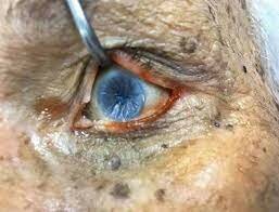 Signo de Stenon- Louis.