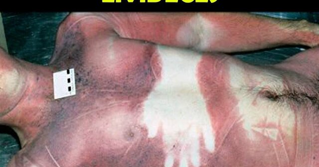 Lividez cadavérica.