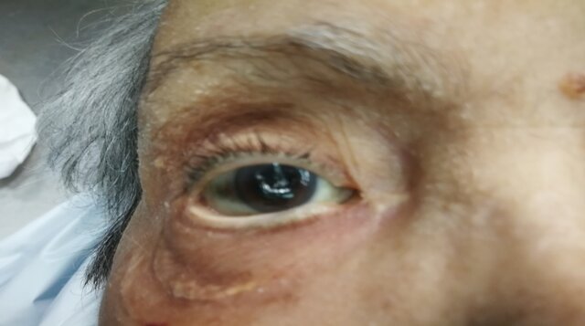 Signo de Stenon - Louis ojos abiertos.