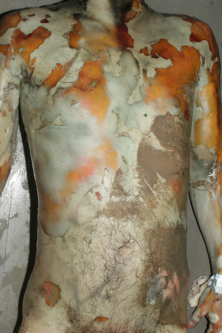 Putrefacción cadavérica.