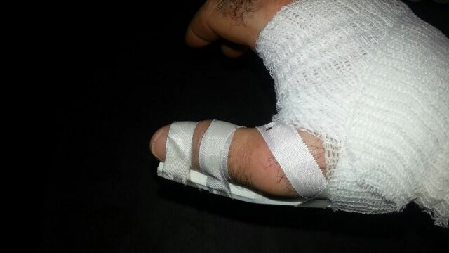 Quan em vaig trencar el dit