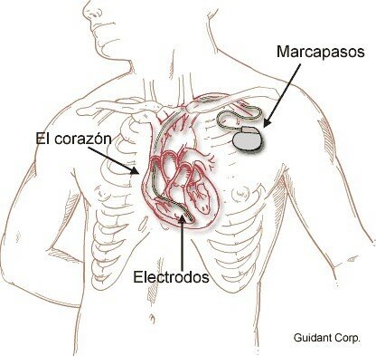 el marcapasos