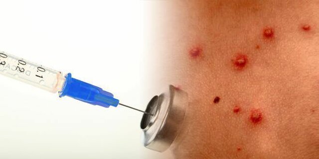 Primera vacuna para la varicela.