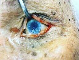 Deshidratación: Signo de Stenon Louis