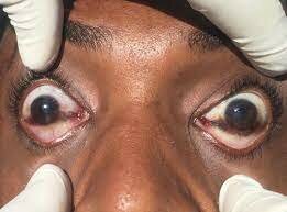 Deshidratación: Signo de Sommer