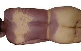 3. LIVOR MORTIS ó Lividez Cadavérica