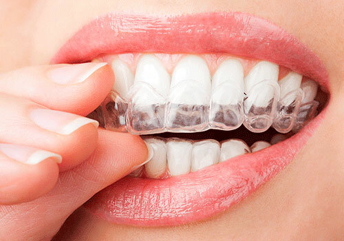 Invisalign (Área de la salud)