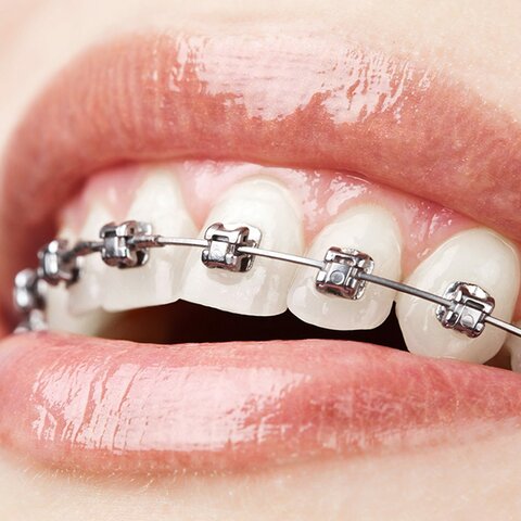 Brackets, noooo
