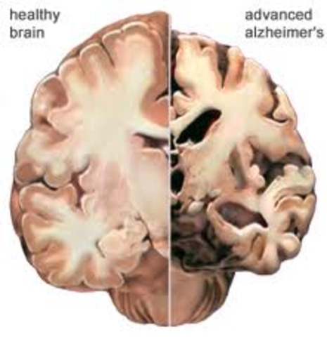 The first case of Alzheimer's disease is identified